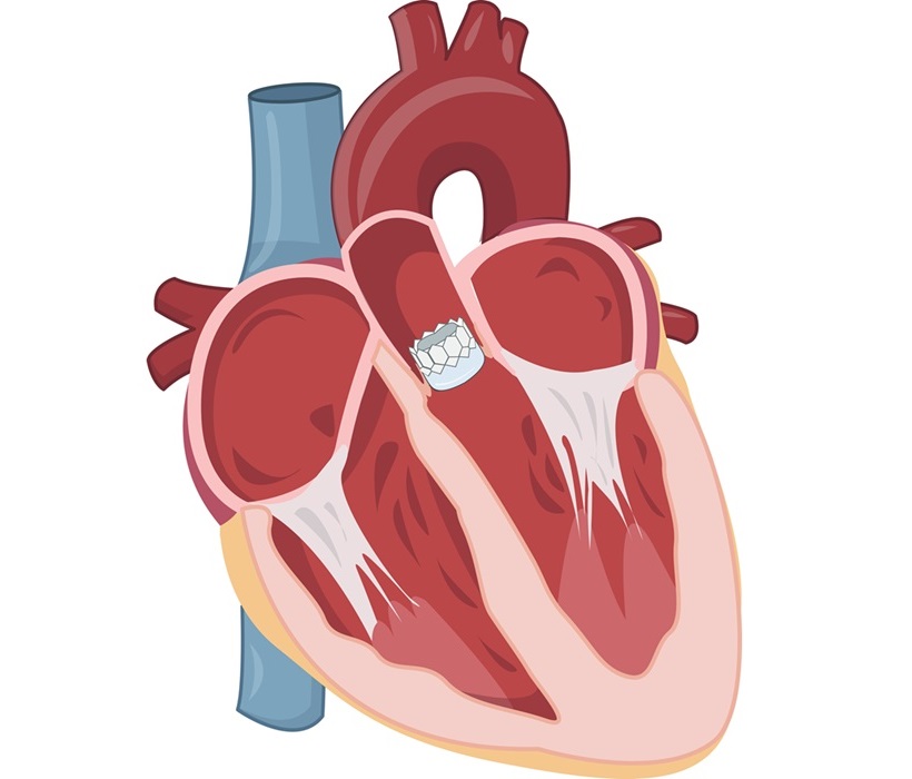 Imagen: Un estudio ha descubierto que la TAVR temprana es beneficiosa para los pacientes con estenosis aórtica grave asintomática (foto cortesía de Shutterstock)